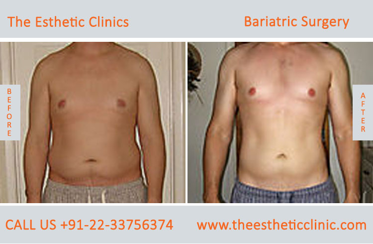 Bariatric Surgery, Weight Loss Surgery before after photos in mumbai india (5)